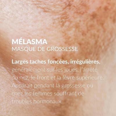 Melasma