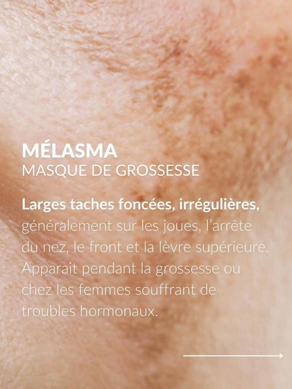 Melasma